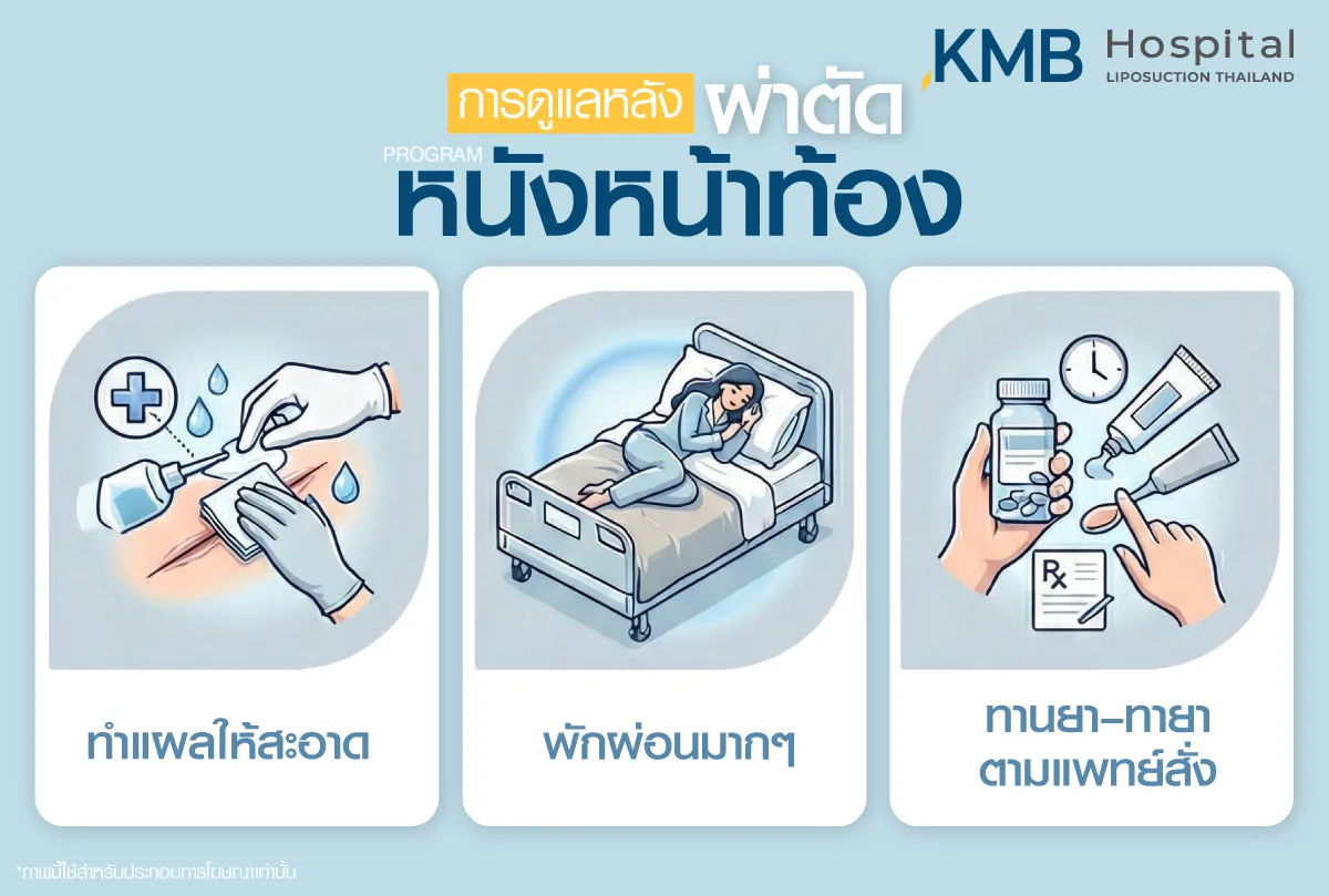 การดูแลหลังผ่าตัดหนังหน้าท้อง