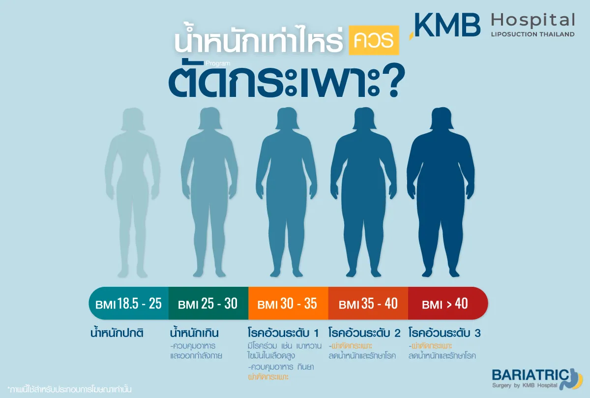 น้ำหนักเท่าไหร่ ควรตัดกระเพาะ - kmb hospital