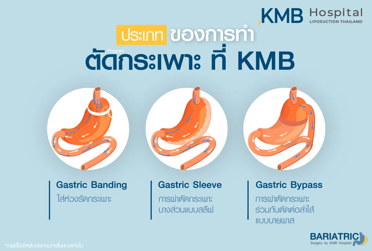 ตัดกระเพาะ - kmb hospital มีแบบไหนบ้าง