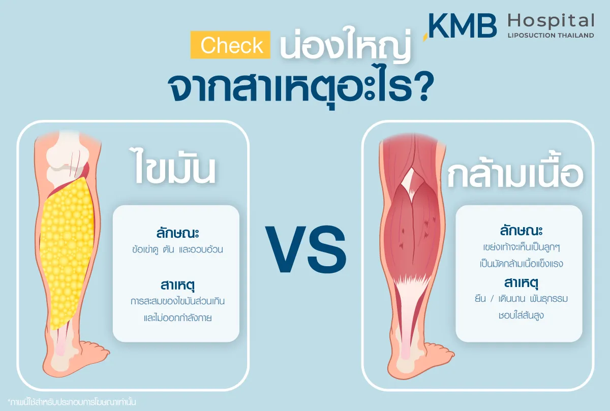 น่องใหญ่ จากสาเหตุอะไร - kmb hodpital - หมอลูกหนู
