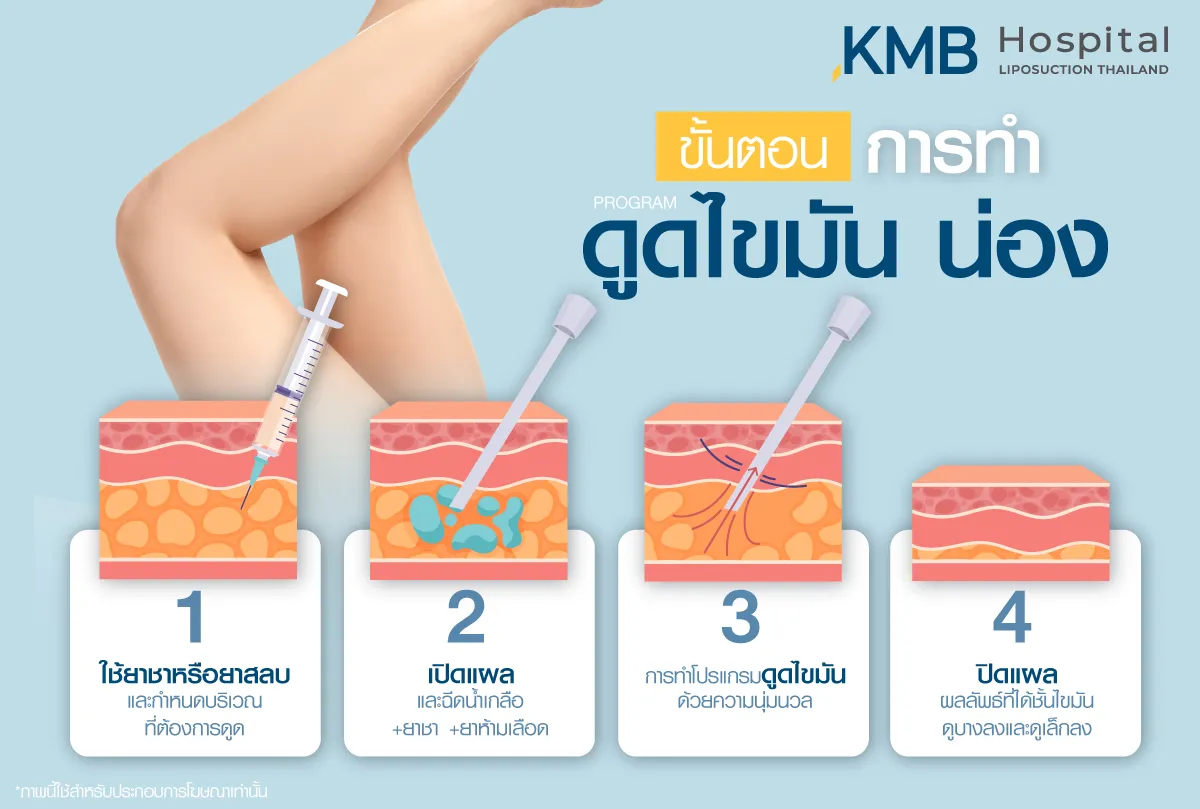 ขั้นตอนการดูดไขมันน่อง - kmb hodpital - หมอลูกหนู