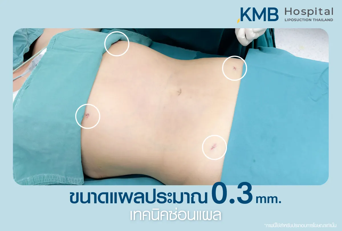 ขนาดแผลดูดไขมัน - kmb hospital - หมอลูกหนู