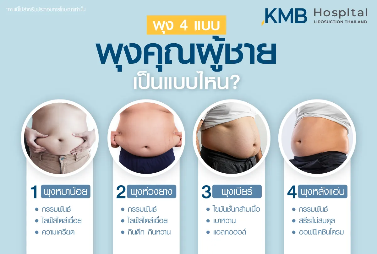พุงผู้ชาย - kmb hospital - หมอลูกหนู