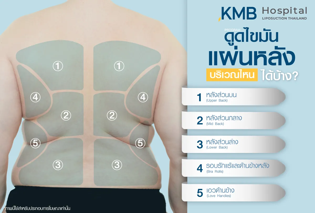ดูดไขมันแผ่นหลัง บริเวณไหนได้บ้าง-kmb hospital