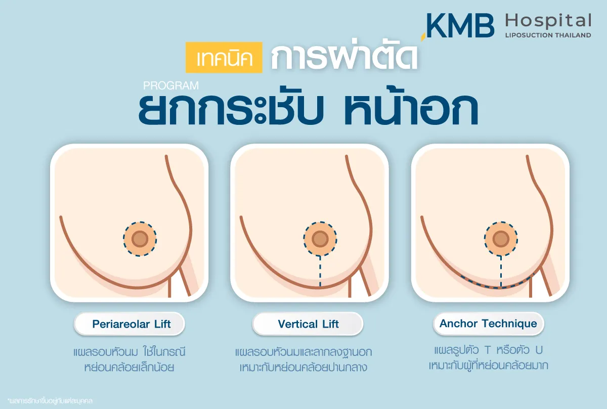 เทคนิค การผ่าตัดยกกระชับหน้าอก - kmb hospital - หมอลูกหนู