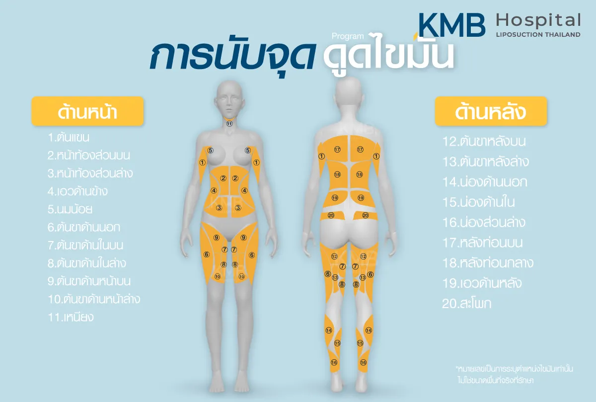 การนับจุดตำแหน่งดูดไขมัน - kmb hospital