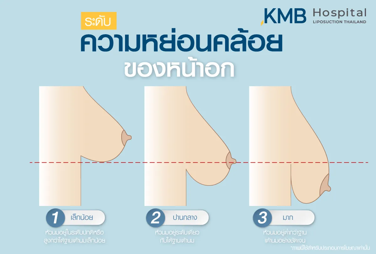 ระดับความหย่อนคล้อย - kmb hospital