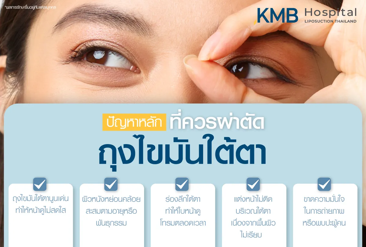 ปัญหาหนักที่ควรผ่าตัดถุงไขมันใต้ตา - kmb hospital - หมอลูกหนู