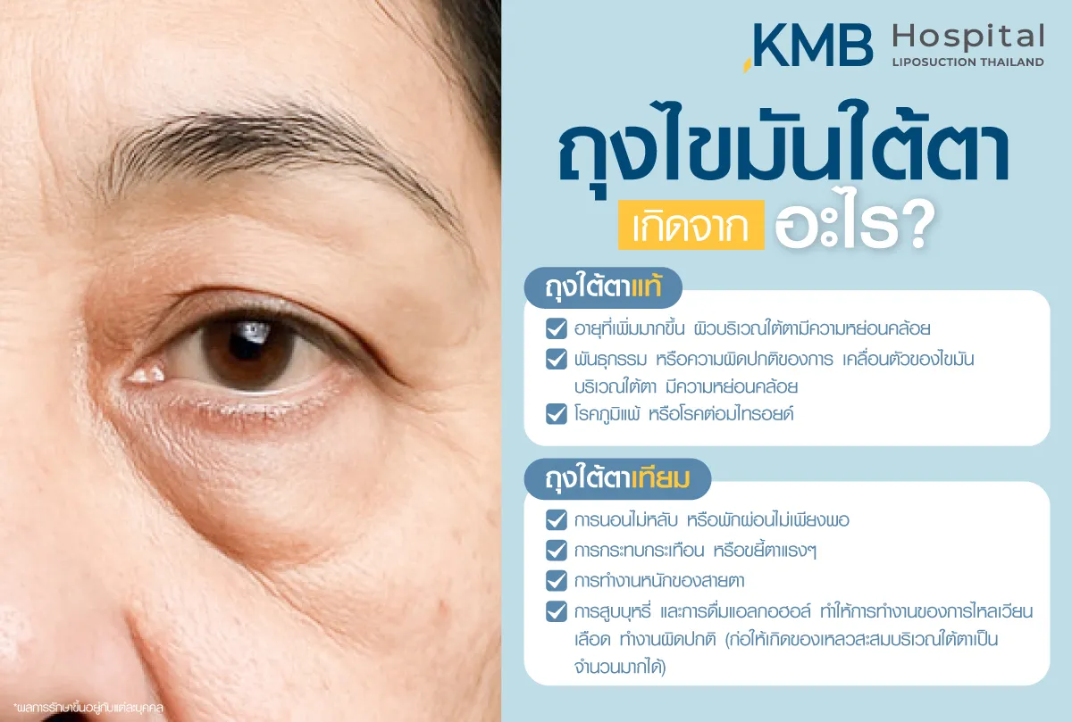 ถุงไขมันใต้ตาเกิดจากอะไร - kmb hospital - หมอลูกหนู