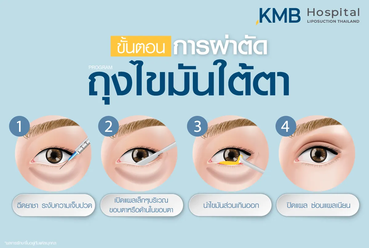 ขั้นตอนการผ่าตัดถุงไขมันใต้ตา - kmb hospital - หมอลูกหนู
