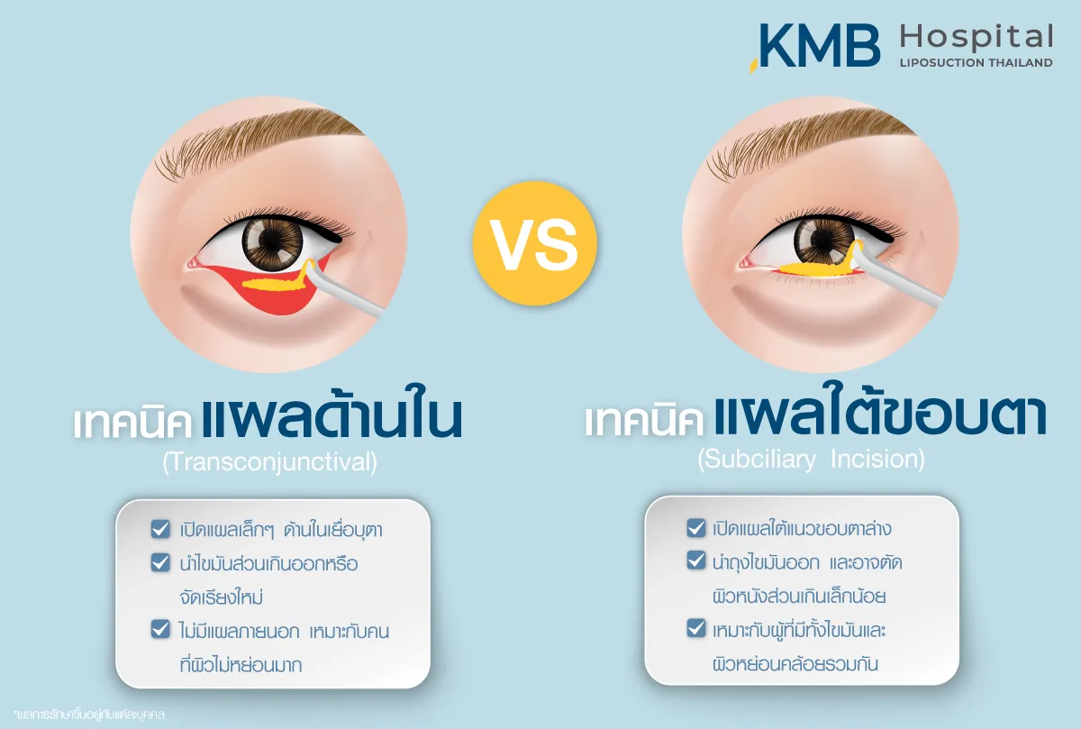 แผลผ่าตัดถุงไขมันใต้ตา- kmb hospital - หมอลูกหนู