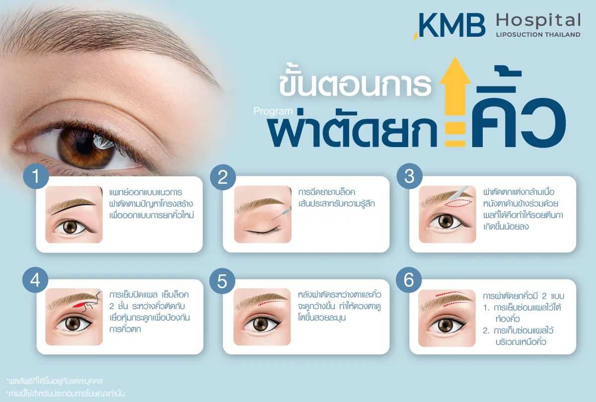 ขั้นตอนผ่าตัดยกคิ้ว - kmb hospital