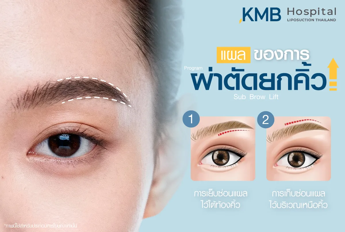 แผลของการผ่าตัดยกคิ้ว - kmb hospital