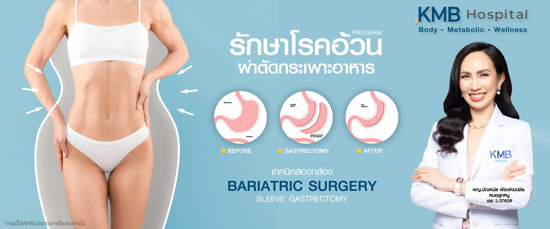 ผ่าตัดกระเพาะอาหาร-ลดน้ำหนัก-หมอลูกหนู-kmb hospital