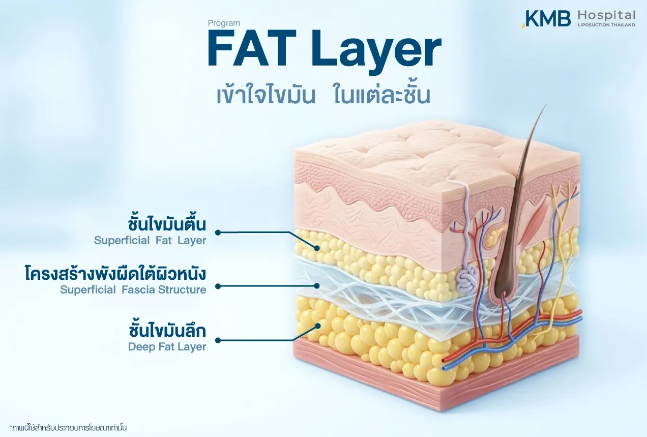 อินโฟกราฟิก KMB Hospital แสดงโครงสร้างชั้นไขมัน ได้แก่ ไขมันตื้น พังผืดใต้ผิวหนัง และไขมันลึก เพื่อช่วยให้เข้าใจความแตกต่างของแต่ละชั้นก่อนวางแผนโปรแกรมดูดไขมัน