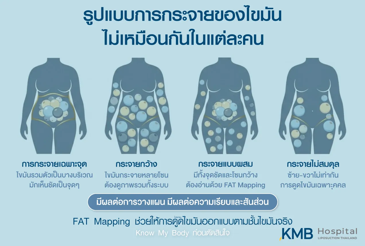 อินโฟกราฟิก KMB Hospital เปรียบเทียบรูปแบบการกระจายของไขมันในแต่ละบุคคล ได้แก่ การกระจายเฉพาะจุด กระจายกว้าง กระจายแบบผสม และกระจายไม่สมดุล ซึ่งส่งผลต่อความเรียบ สัดส่วน และแนวทางวางแผนโปรแกรมดูดไขมัน