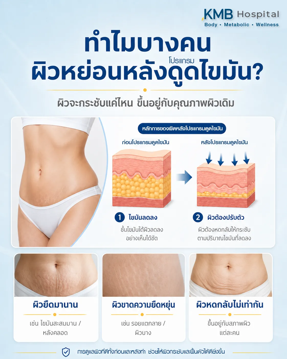 อินโฟกราฟิกอธิบายเหตุผลที่บางคนอาจมีผิวหย่อนหลังดูดไขมัน เช่น ผิวยืดมานาน ผิวขาดความยืดหยุ่น และผิวหดกลับไม่เท่ากัน พร้อมภาพจำลองชั้นผิวและไขมัน