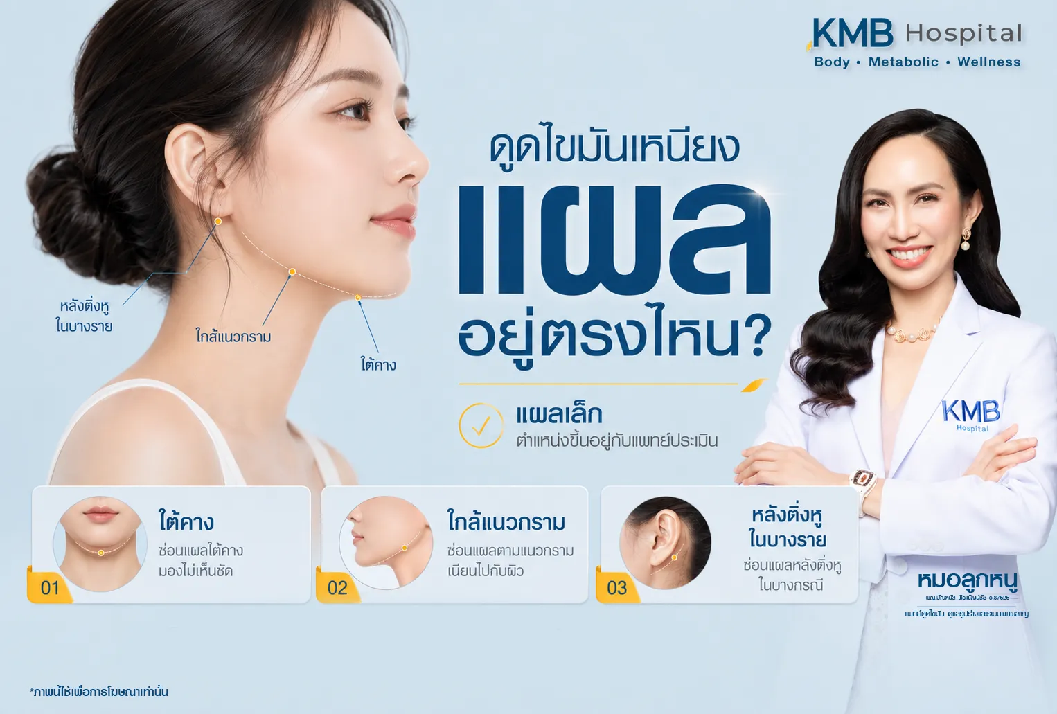ภาพอินโฟกราฟิก KMB Hospital อธิบายตำแหน่งแผลของโปรแกรมดูดไขมันเหนียง ซึ่งอาจอยู่บริเวณใต้คาง ใกล้แนวกราม หรือหลังติ่งหูในบางราย โดยเป็นแผลขนาดเล็กและตำแหน่งขึ้นอยู่กับการประเมินของแพทย์