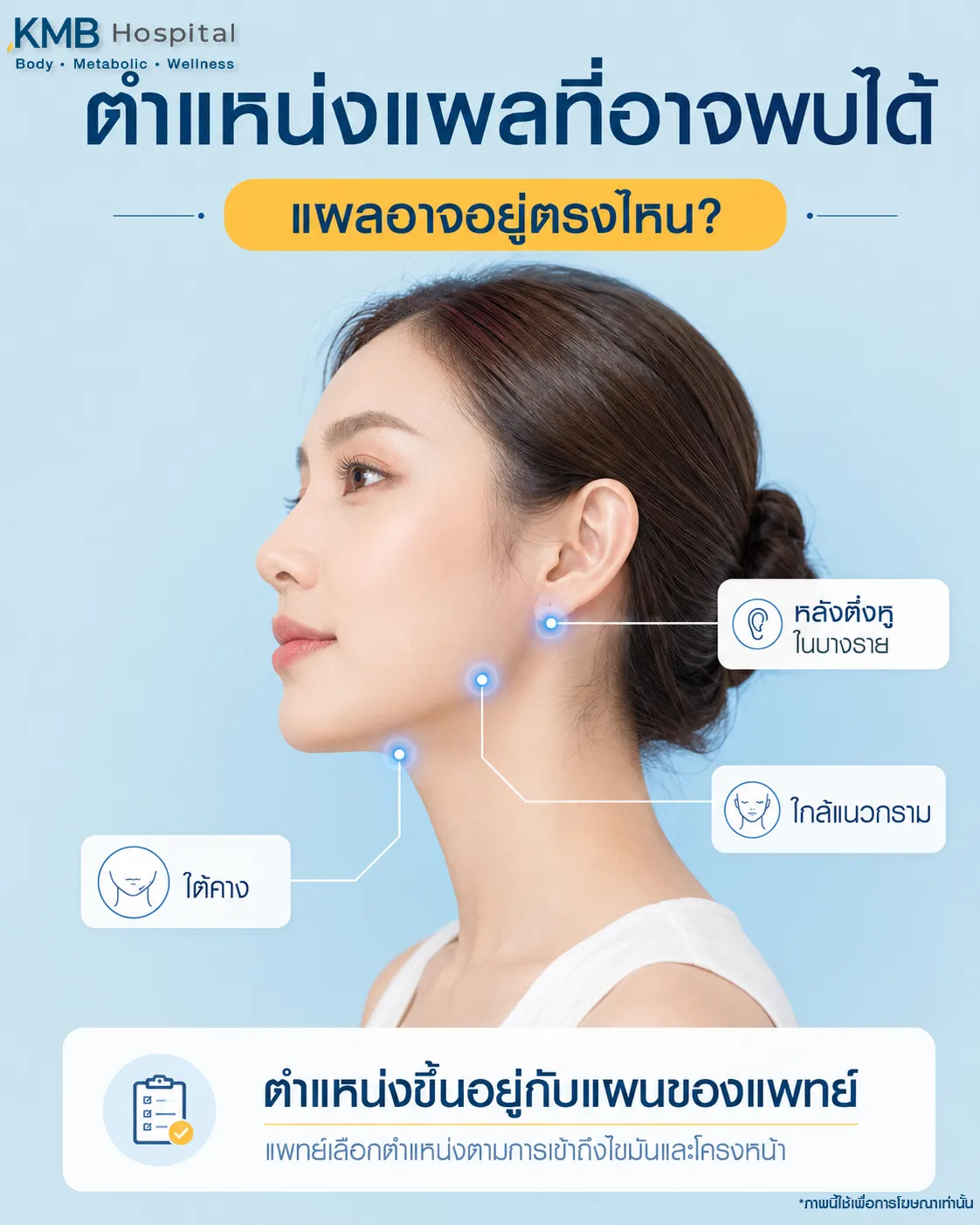 ภาพอินโฟกราฟิก KMB Hospital แสดงตำแหน่งแผลที่อาจพบจากโปรแกรมดูดไขมันเหนียง ได้แก่ ใต้คาง ใกล้แนวกราม และหลังติ่งหูในบางราย โดยแพทย์เลือกตำแหน่งตามการเข้าถึงไขมันและโครงหน้า
