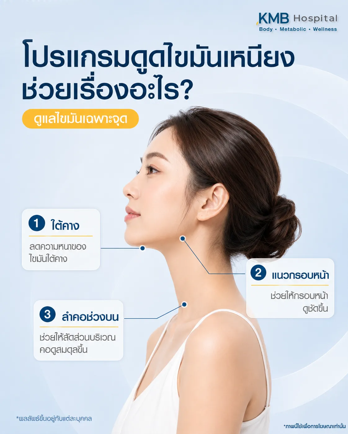 ภาพอินโฟกราฟิก KMB Hospital อธิบายว่าโปรแกรมดูดไขมันเหนียงช่วยลดความหนาของไขมันใต้คาง ช่วยให้แนวกรอบหน้าดูชัดขึ้น และทำให้สัดส่วนคอช่วงบนดูสมดุลขึ้น โดยผลลัพธ์แตกต่างกันในแต่ละบุคคล