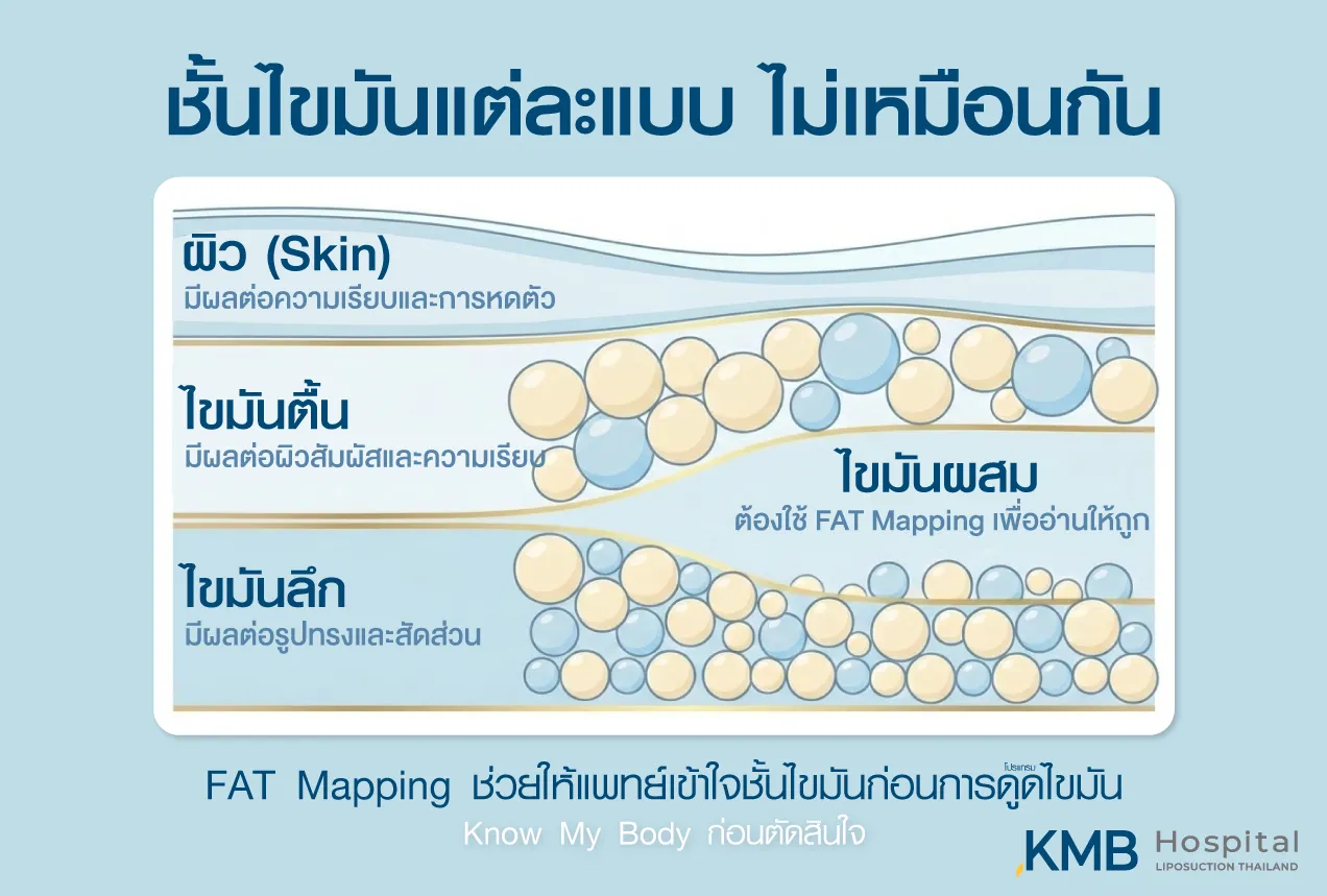 อินโฟกราฟิก KMB Hospital อธิบายความแตกต่างของผิว ไขมันตื้น ไขมันลึก และไขมันแบบผสม ซึ่งแต่ละชั้นส่งผลต่อความเรียบของผิว รูปทรง และสัดส่วนแตกต่างกัน เพื่อช่วยวางแผนโปรแกรมดูดไขมันได้เหมาะสมยิ่งขึ้น
