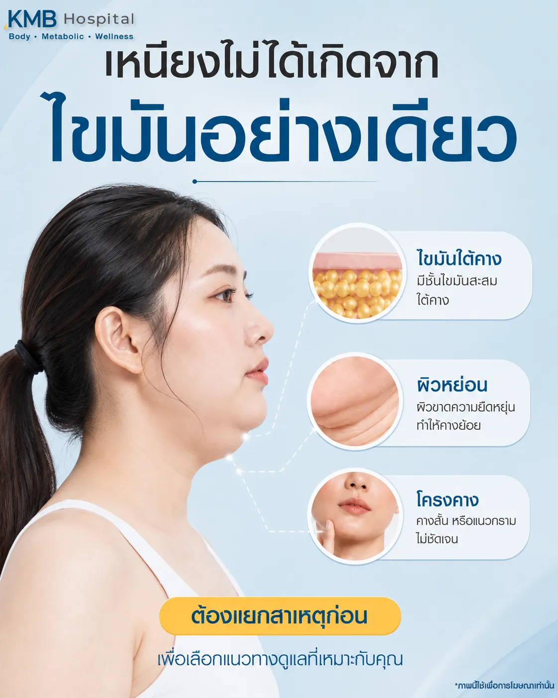 ภาพอินโฟกราฟิก KMB Hospital อธิบายว่าเหนียงไม่ได้เกิดจากไขมันเพียงอย่างเดียว แต่อาจเกี่ยวข้องกับไขมันใต้คาง ผิวหย่อน และโครงคาง จึงควรแยกสาเหตุก่อนเลือกแนวทางดูแลที่เหมาะสม