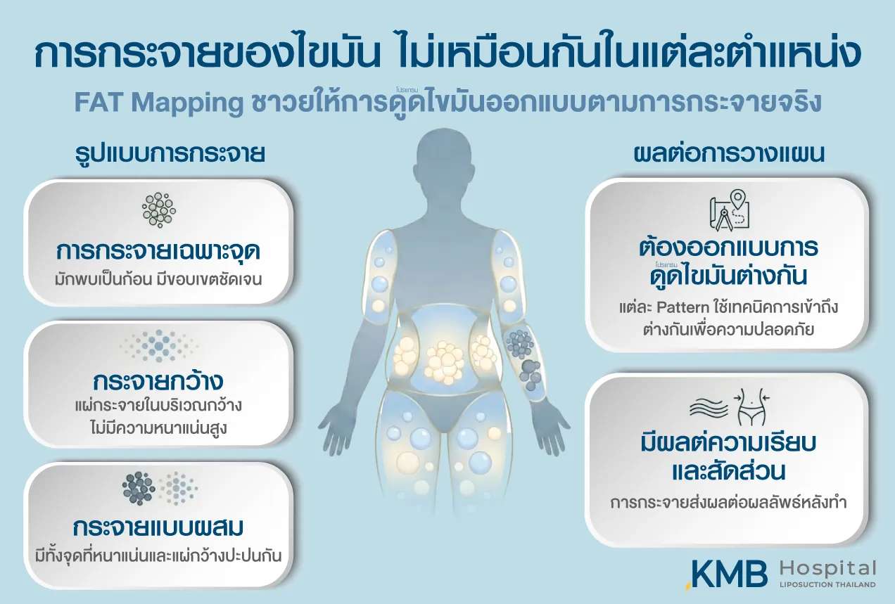 อินโฟกราฟิก KMB Hospital อธิบายรูปแบบการกระจายของไขมันที่แตกต่างกันในแต่ละตำแหน่ง ได้แก่ การกระจายเฉพาะจุด การกระจายกว้าง และการกระจายแบบผสม ซึ่งมีผลต่อเทคนิคการวางแผน ความเรียบ และสัดส่วนหลังโปรแกรมดูดไขมัน