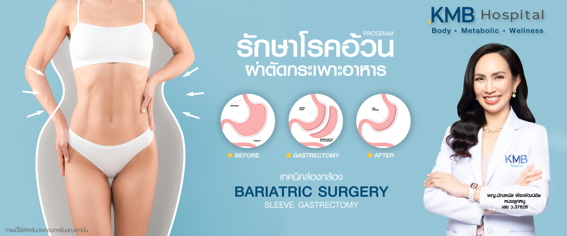 ผ่าตัดกระเพาะ รักษาโรคอ้วน - หมอลูกหนู - kmb hospital