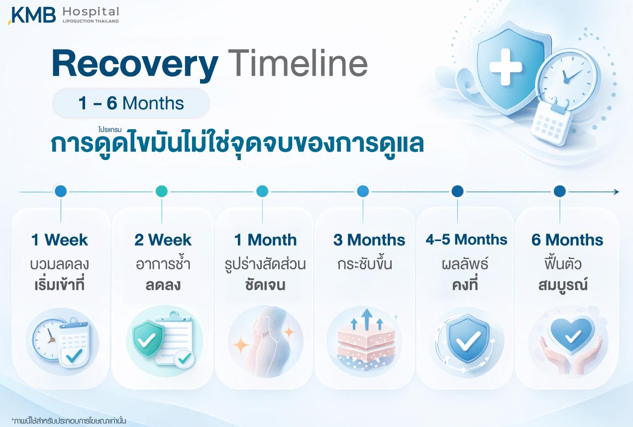 อินโฟกราฟิก KMB Hospital แสดงไทม์ไลน์การฟื้นตัวหลังโปรแกรมดูดไขมันในช่วง 1–6 เดือน ตั้งแต่เริ่มเข้าที่ อาการช้ำลดลง รูปร่างและสัดส่วนชัดเจนขึ้น ไปจนถึงผลลัพธ์คงที่และฟื้นตัวสมบูรณ์