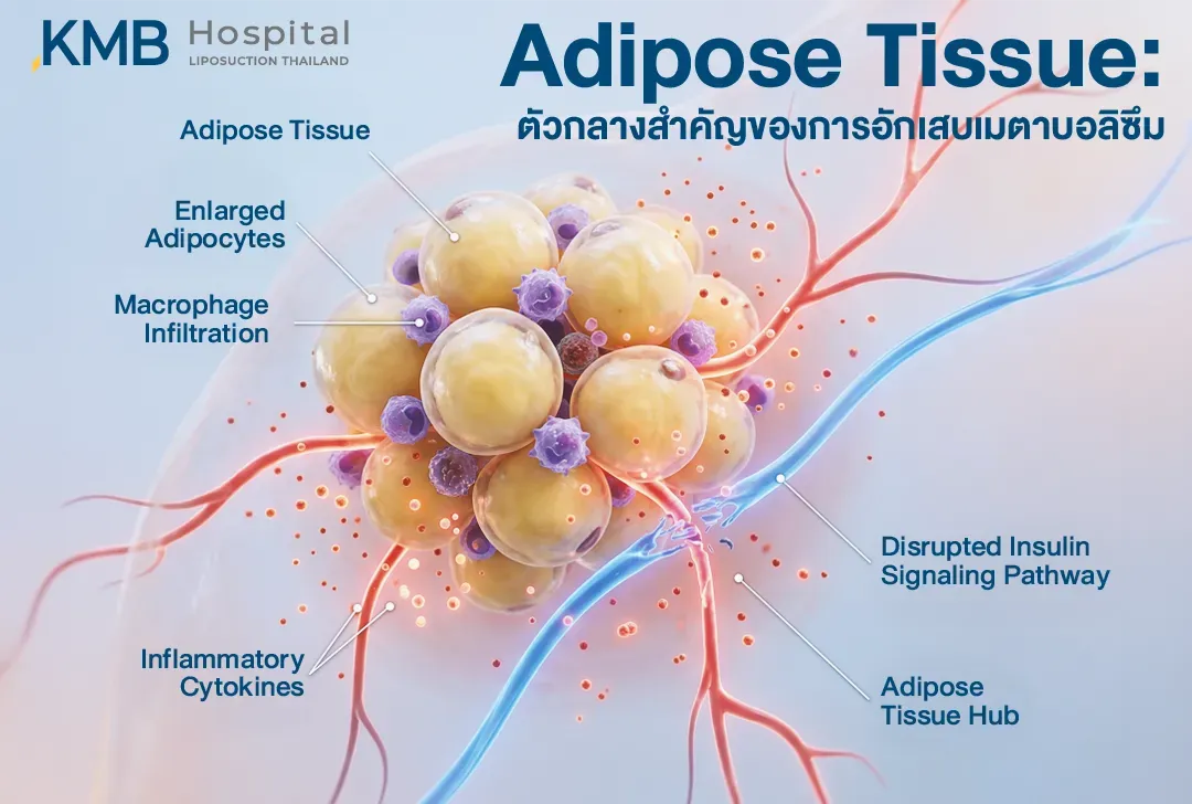 อินโฟกราฟิกแสดงเนื้อเยื่อไขมันที่มีเซลล์ไขมันขยายตัว การแทรกซึมของ Macrophage และการหลั่ง Inflammatory Cytokines ซึ่งอาจรบกวนเส้นทางการส่งสัญญาณของอินซูลินและสัมพันธ์กับการอักเสบทางเมตาบอลิซึม