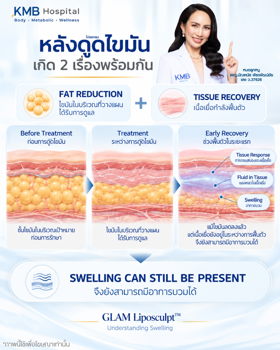 อินโฟกราฟิกอธิบายความแตกต่างระหว่างไขมันและอาการบวมของเนื้อเยื่อหลังดูดไขมัน