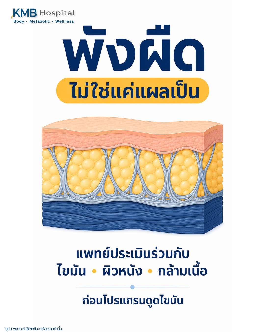 อินโฟกราฟิกสรุปบทบาทของพังผืดในชั้นไขมันและความสำคัญต่อการประเมินก่อนดูดไขมัน