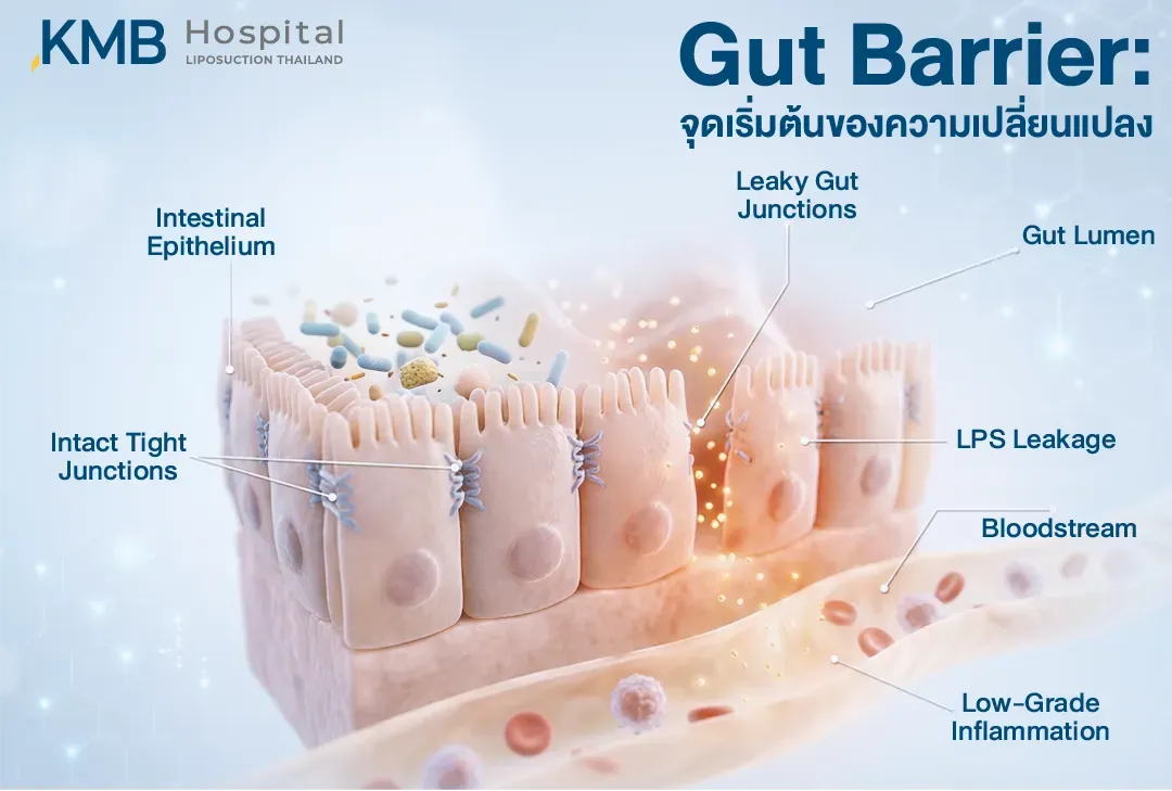 อินโฟกราฟิกแสดงโครงสร้าง Gut Barrier เปรียบเทียบ Intact Tight Junctions กับ Leaky Gut Junctions ซึ่งอาจทำให้ LPS ผ่านเข้าสู่กระแสเลือดและกระตุ้นการอักเสบระดับต่ำ