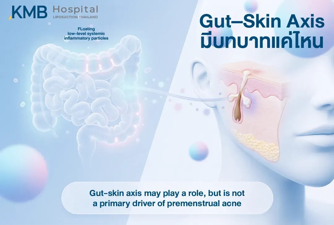 อินโฟกราฟิกแสดงความเชื่อมโยงระหว่างลำไส้และผิวหนังผ่าน Gut–Skin Axis โดยการอักเสบระดับต่ำอาจมีส่วนปรับความรุนแรงของสิวช่วงก่อนมีประจำเดือน แต่ไม่ใช่ปัจจัยหลักที่ทำให้เกิดสิว