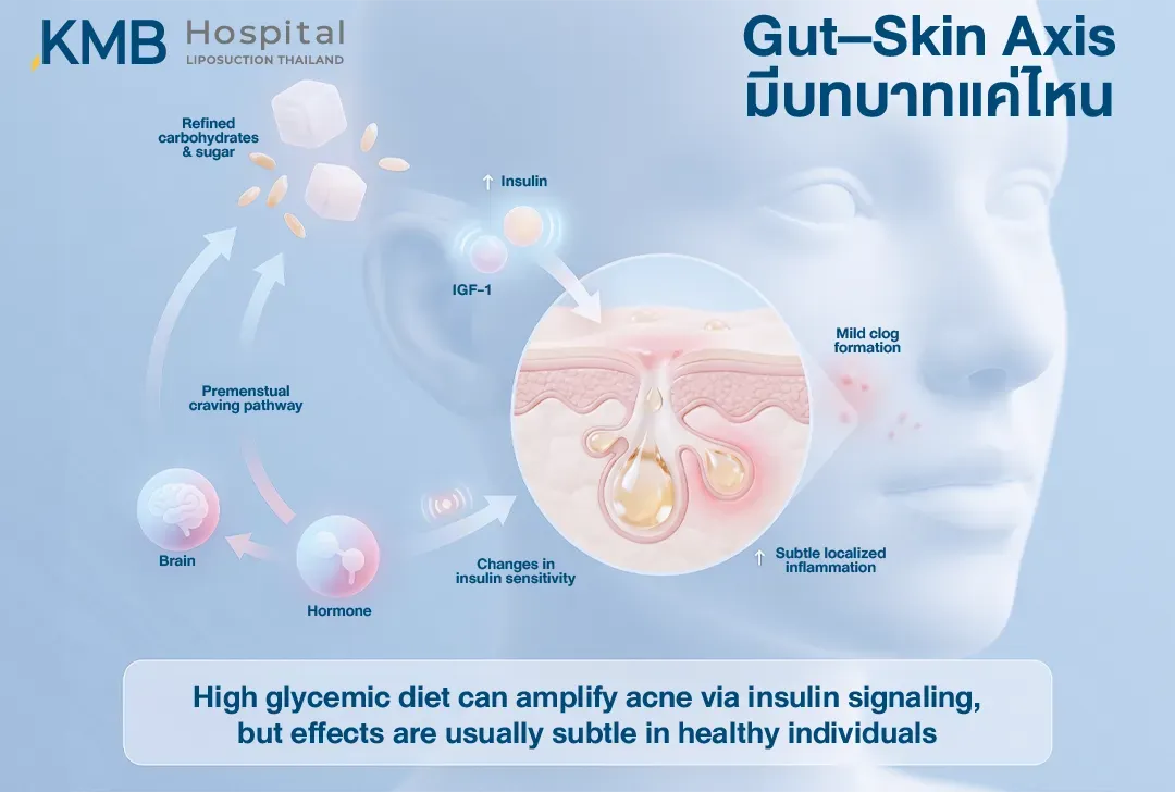 อินโฟกราฟิก Gut–Skin Axis แสดงว่าอาหารคาร์โบไฮเดรตขัดสีและน้ำตาลสูงอาจเพิ่มสัญญาณ Insulin และ IGF-1 ซึ่งเกี่ยวข้องกับการอุดตันของรูขุมขนและการอักเสบเฉพาะที่ของสิวช่วงก่อนมีประจำเดือน