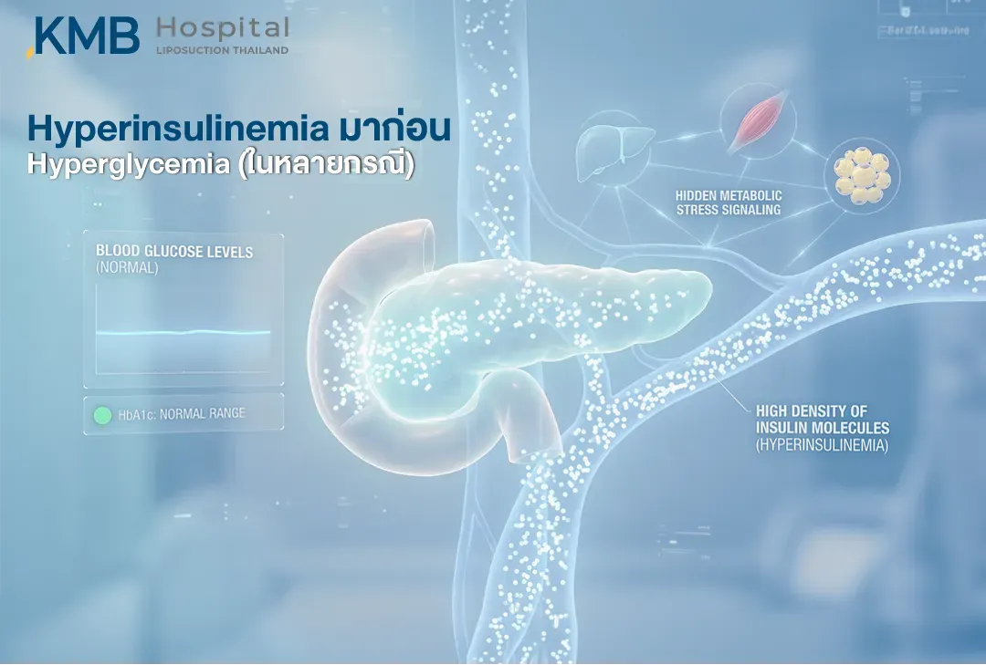 อินโฟกราฟิกแสดงภาวะ Hyperinsulinemia ที่อาจเกิดขึ้นก่อน Hyperglycemia ในบางกรณี โดยตับอ่อนหลั่งอินซูลินเพิ่มขึ้นเพื่อช่วยรักษาระดับน้ำตาลในเลือดและค่า HbA1c ให้อยู่ในช่วงปกติ