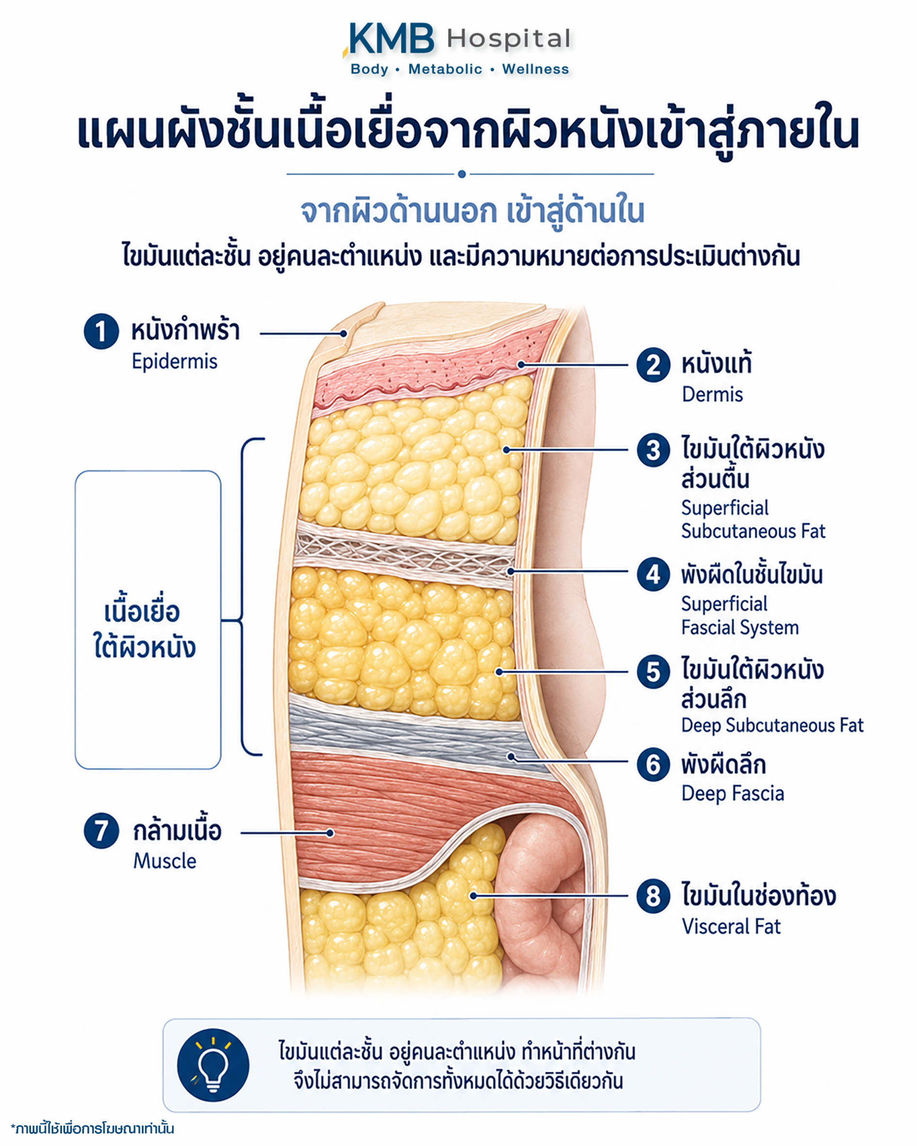 ภาพตัดขวางแสดงหนังกำพร้า หนังแท้ ไขมันใต้ผิวหนังส่วนตื้น พังผืด ไขมันส่วนลึก กล้ามเนื้อ และไขมันในช่องท้อง