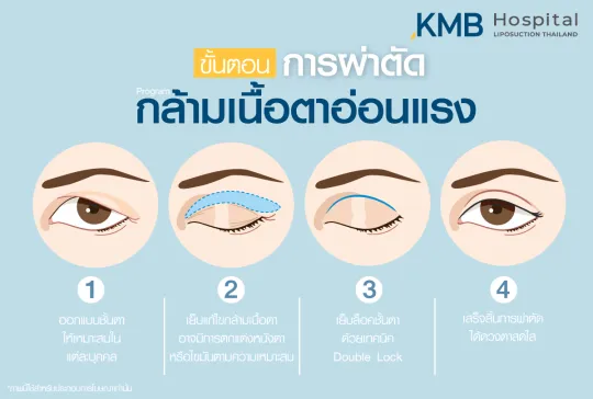 ขั้นตอนการผ่าตัดกล้ามเนื้อหาอ่อนแรง
