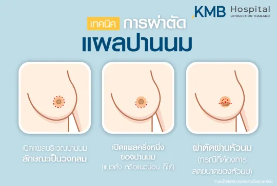 แผลปานนม - kmb hospital - หมอลูกหนู