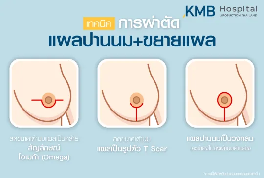 แผลปานนมและขยายแผล - kmb hospital - หมอลูกหนู