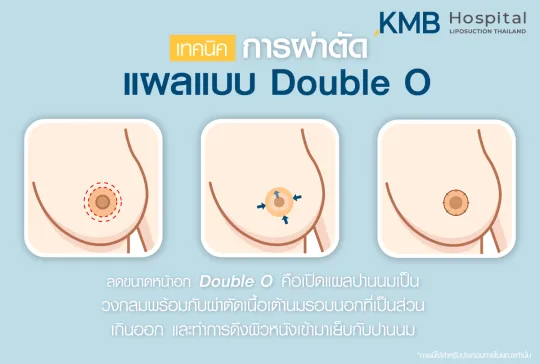 แผลแบบดับเบิ้ลโอ - kmb hospital - หมอลูกหนู