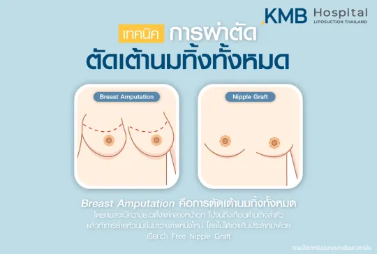 การตัดนมทั้งหมด - kmb hospital - หมอลูกหนู